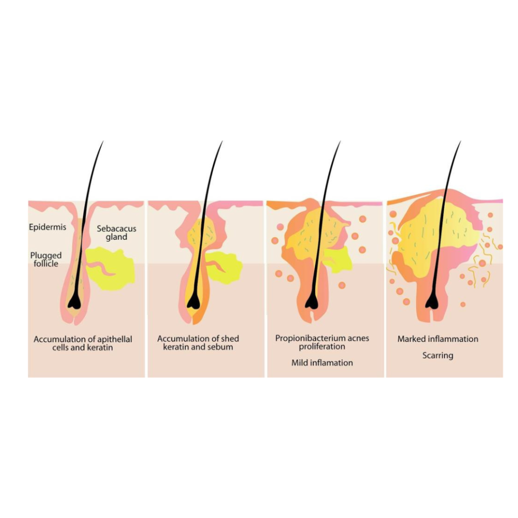 Mécanisme acné hormonal
nutritionniste saint-chamas